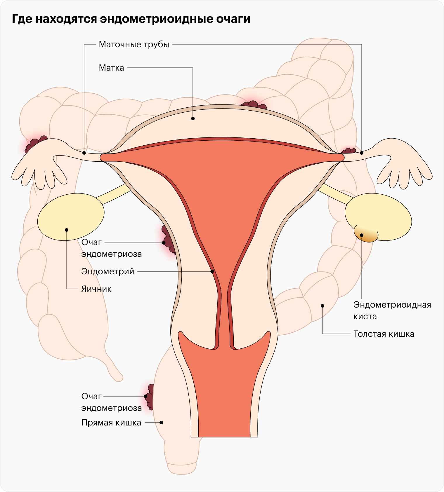 Почему развивается эндометриоз и его классификация
