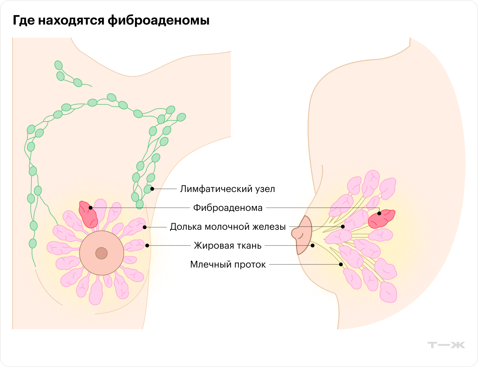 Чаще всего фиброаденомы формируются в верхней наружной части груди