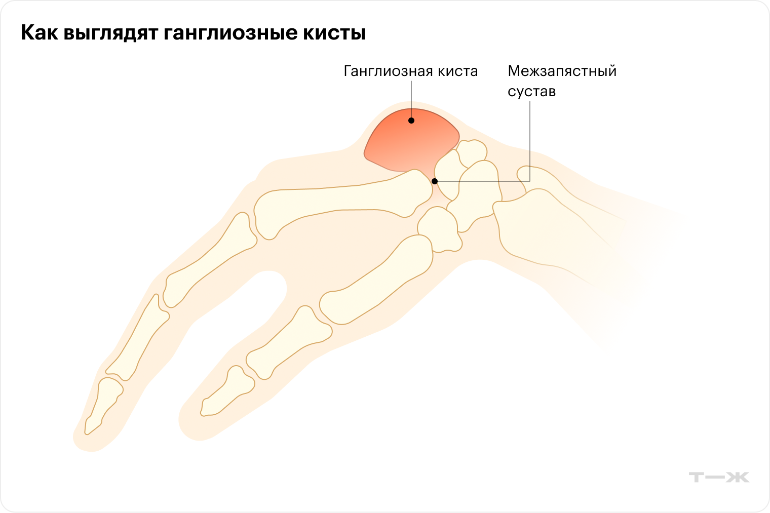 Образование может быть округлым или овальным, располагается на тонкой ножке и заполнено вязкой жидкостью