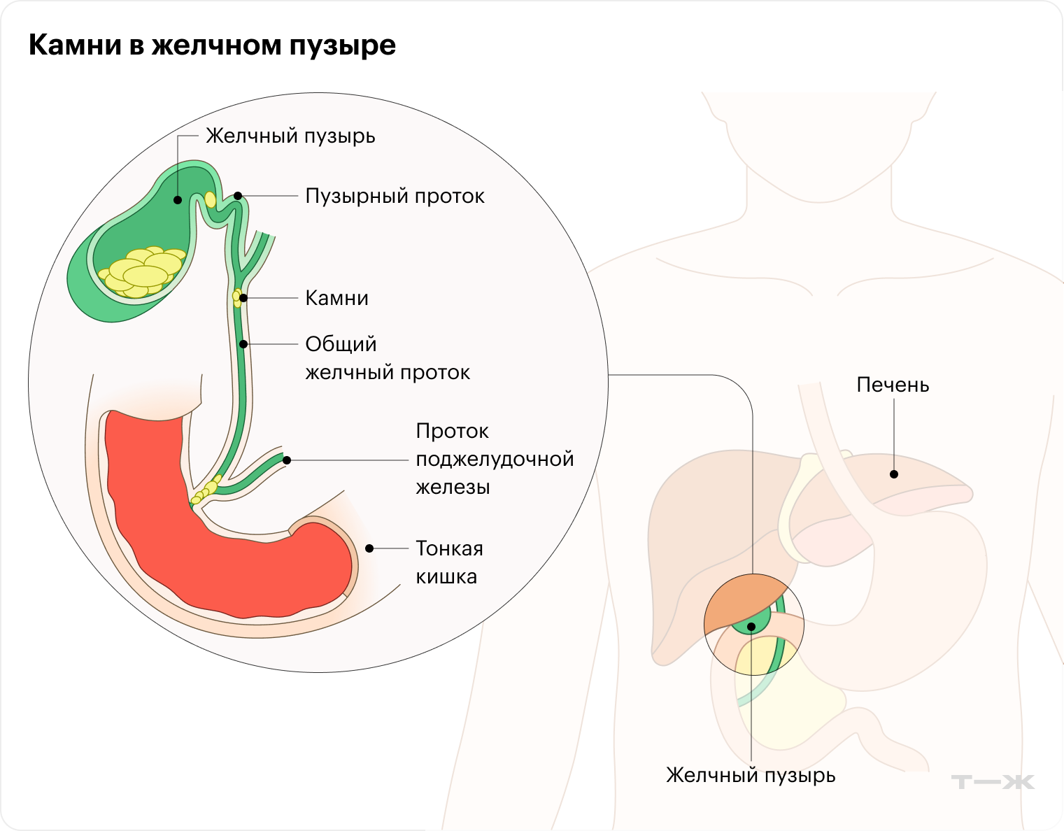 Из желчного пузыря камни могут мигрировать в протоки и закупоривать их