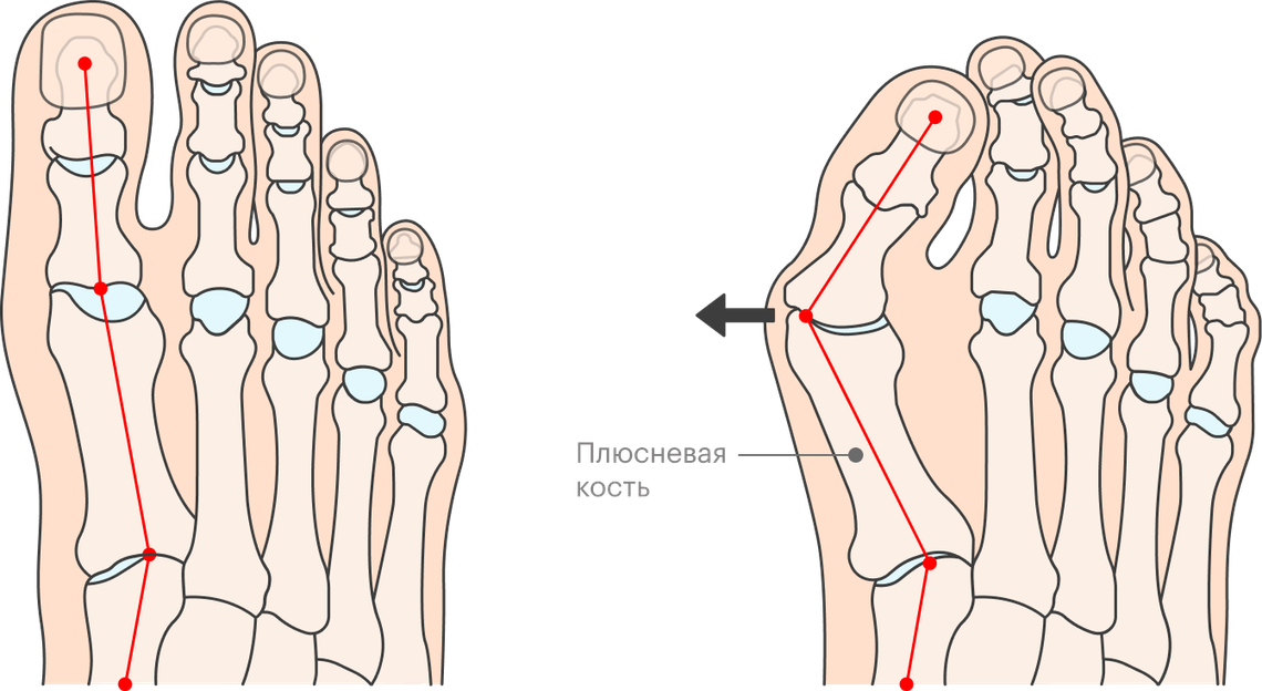 Влияние неудобной обуви на организм
