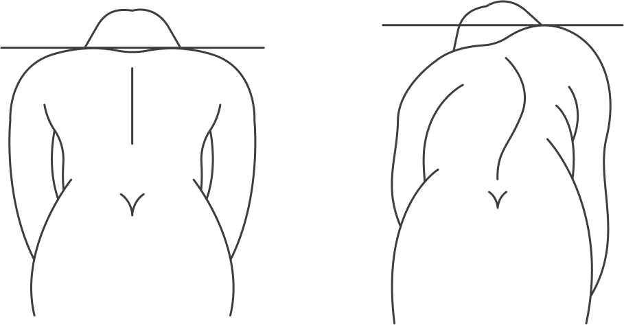 При наклоне с одной стороны спины заметен валик, также одно плечо находится ниже другого