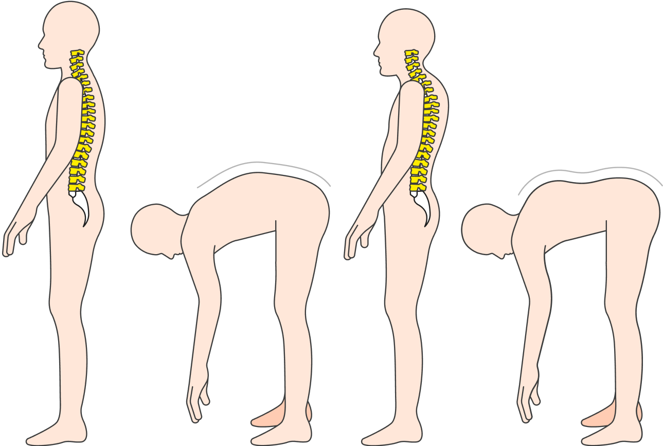 Грудной кифоз тоже видно по искривлению спины стоя и в наклоне