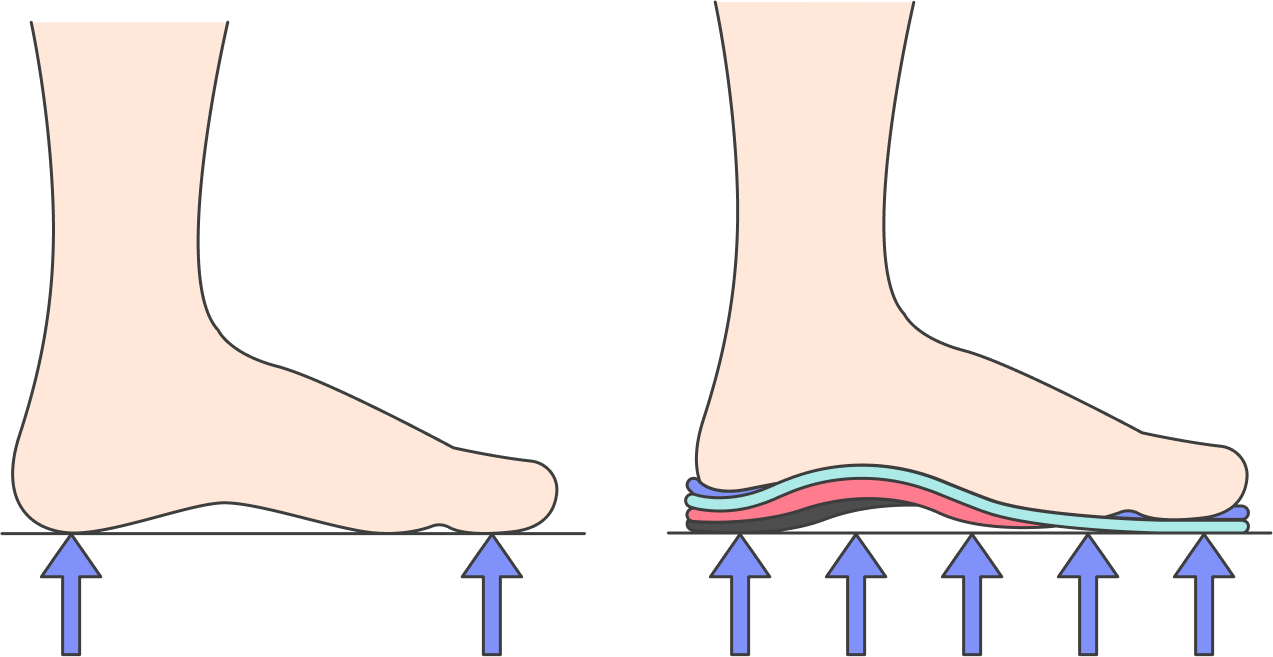 Ортопедическая стелька поддерживает стопу, за счет этого она может уменьшить боль и усталость, скорректировать походку. Но форму стопы ни она, ни ортопедическая обувь не изменят