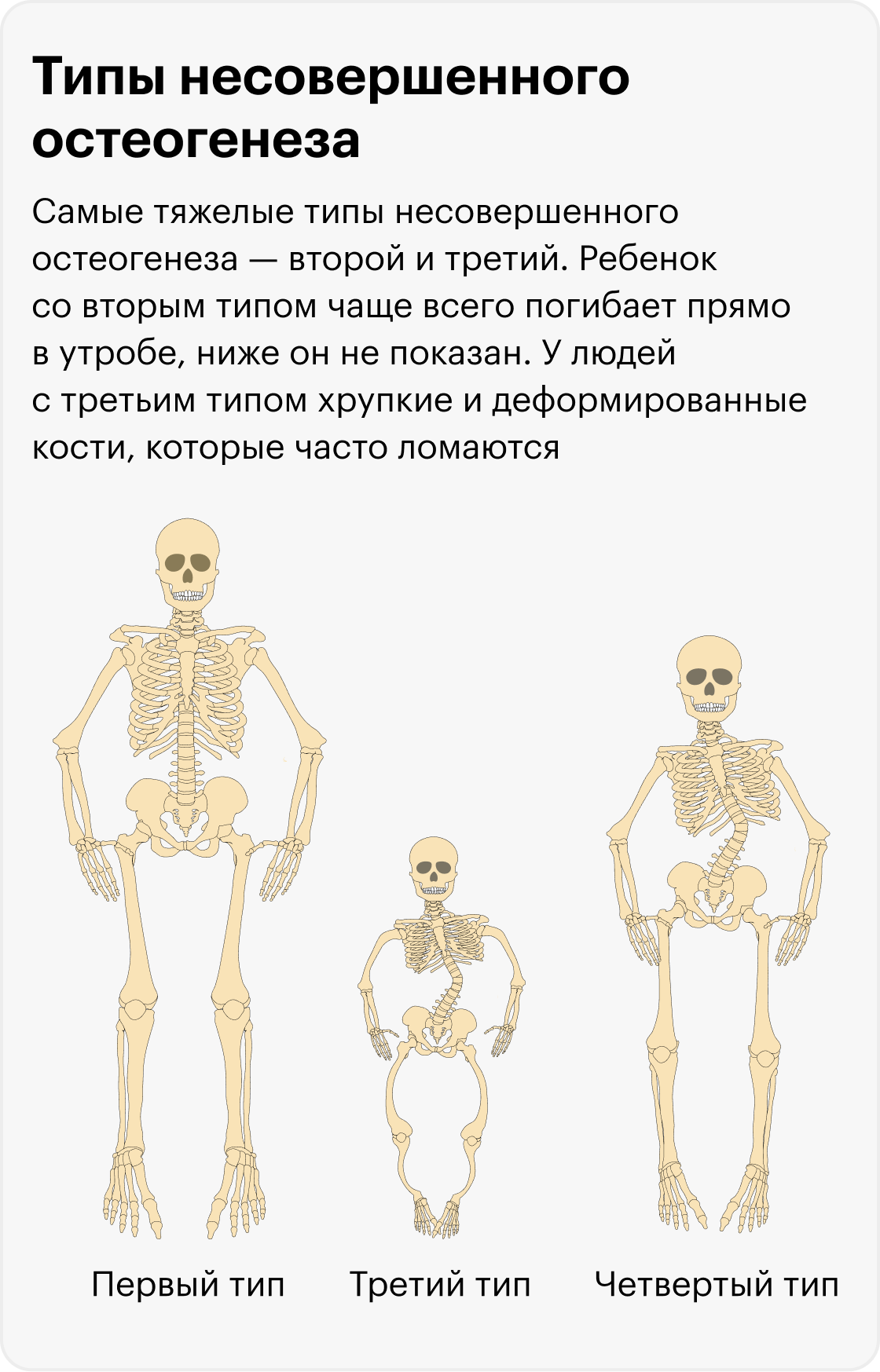 Чаще всего у людей с несовершенным остеогенезом первый тип болезни. Внешне их трудно отличить от здорового человека