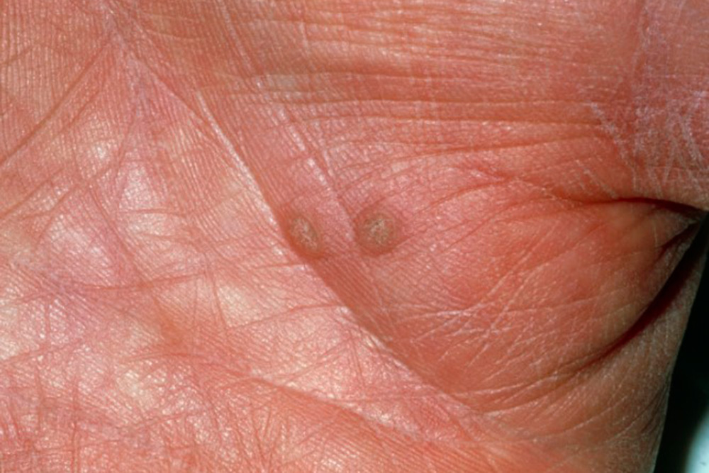 А это бородавка на ладони. Источник: справочник MSD