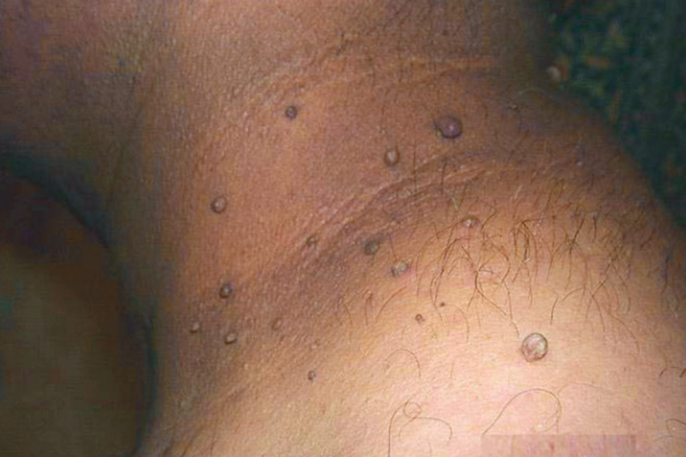 Папилломы на шее — мелкие, мягкие кожные образования на ножке. Источник: справочник MSD