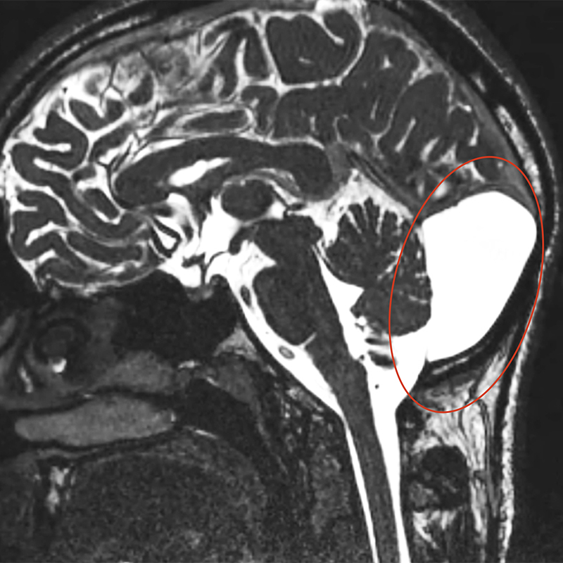 Вот как может выглядеть арахноидальная киста на мозжечке. Этот снимок я взяла из интернета — мой потерялся. Источник: Radiopaedia.org