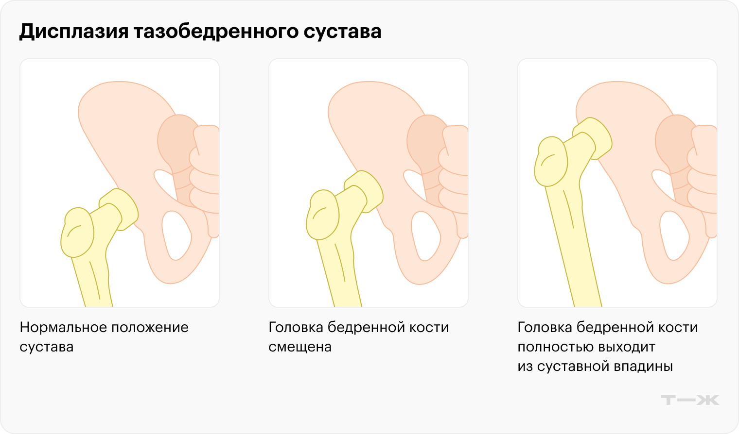 Слева — нормальный тазобедренный сустав. При дисплазии сустав развивается неправильно, головка бедренной кости смещена, а иногда и полностью выходит из суставной впадины