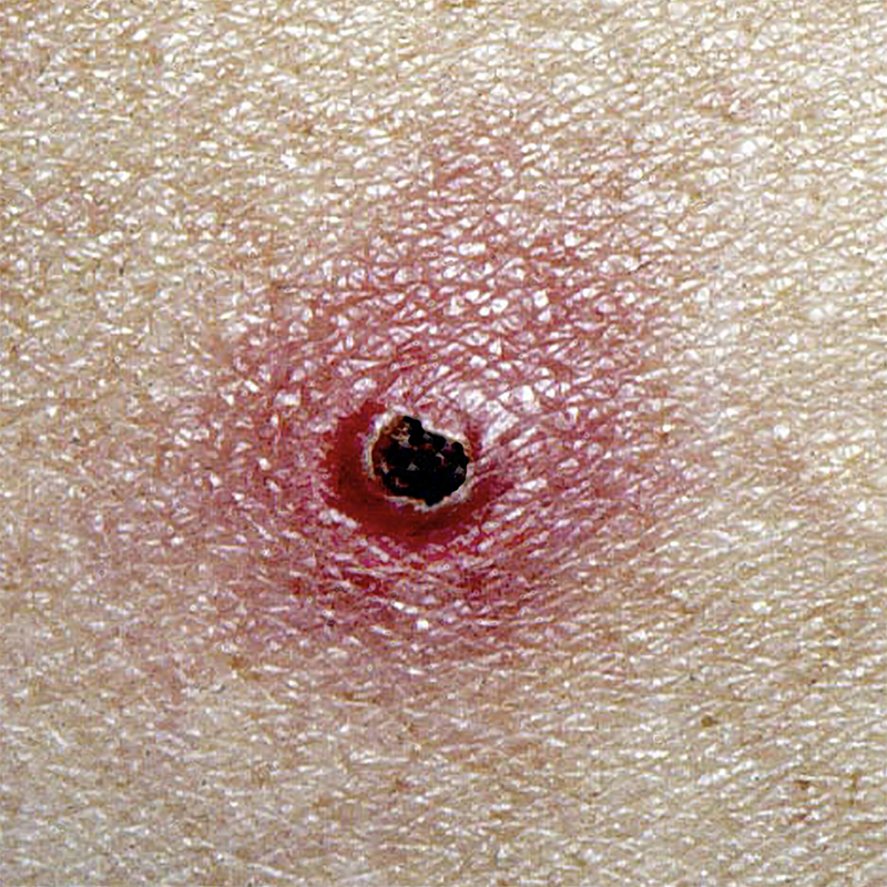 Красный узелок на коже при болезни кошачьих царапин. Источник: msdmanuals.com