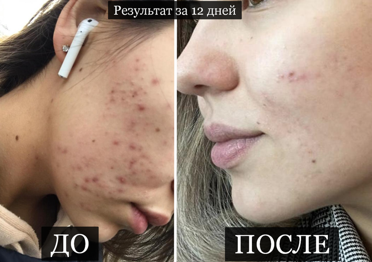Косметика для борьбы с прыщами - секрет состава средства, которое поможет избавиться от проблемы Косметика для борьбы с прыщами: что искать в составе средства