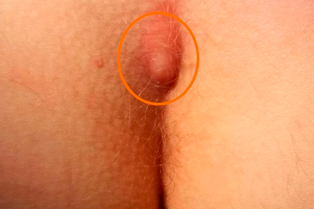 Источник: клиника колопроктологии ПМГМУ им. И. М. Сеченова