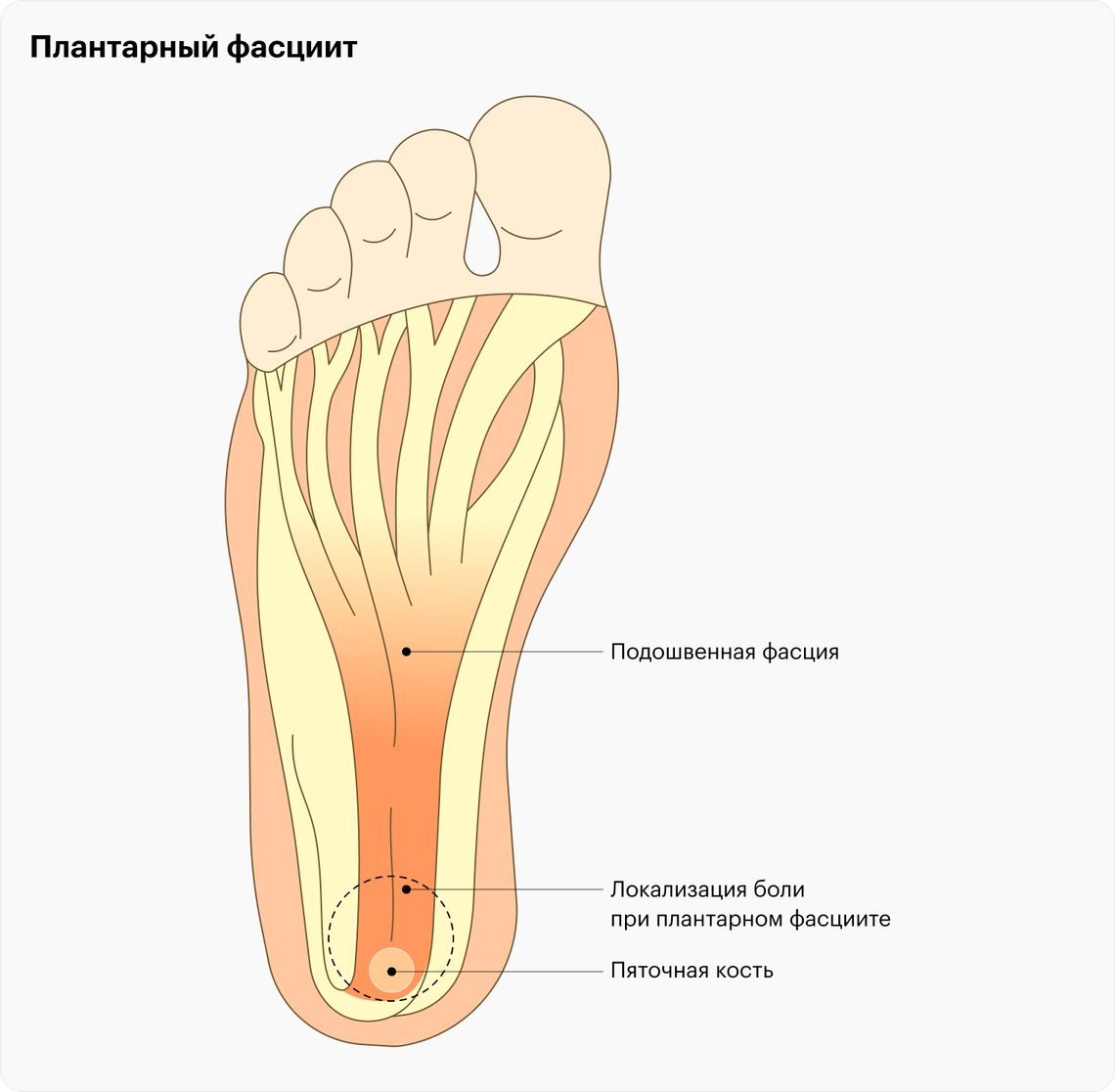 Почему болят пятки: симптомы плантарного фасциита, как лечить боли в пятках  при ходьбе