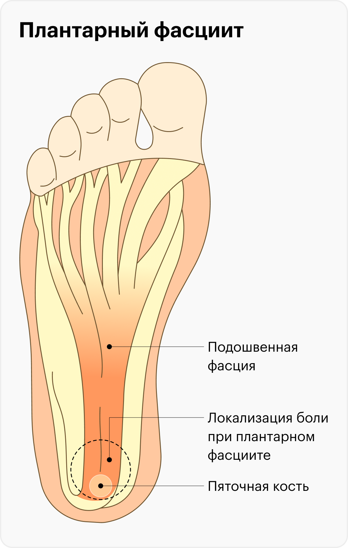 Почему болят пятки: симптомы плантарного фасциита, как лечить боли в пятках  при ходьбе