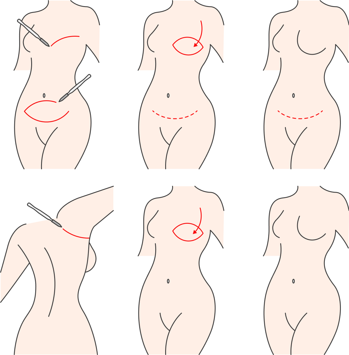 Для восстановления груди лоскут ткани могут забирать со спины или области живота