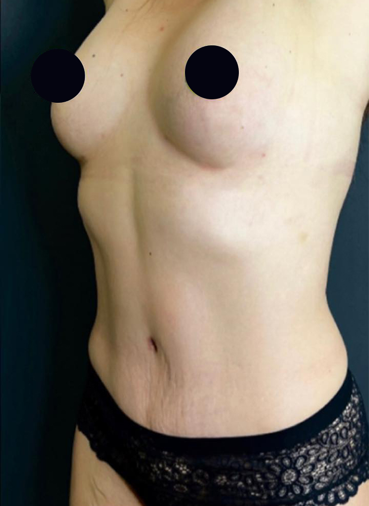 Абдоминопластика с липосакцией, ушиванием диастаза и одновременным липофилингом груди
