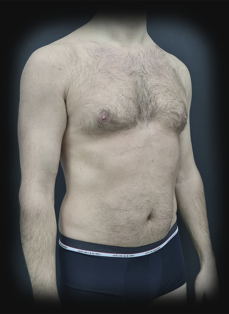 Мужская липоскульптура с формированием спортивного рельефа живота, липофилинг больших грудных и дельтовидных мышц