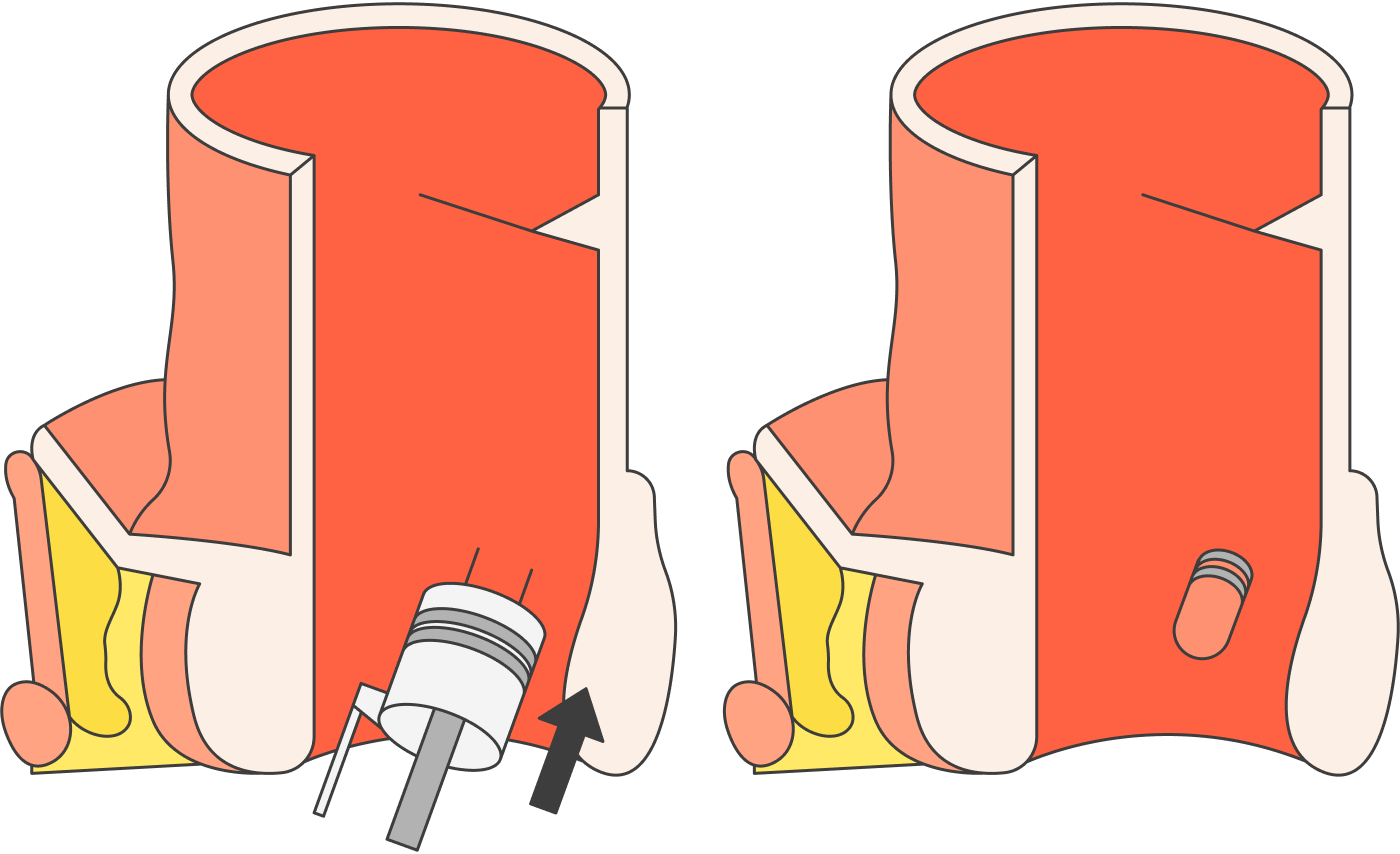 При лигировании на геморроидальный узел надевают латексное колечко, чтобы пережать кровоток. После этого узел должен отвалиться сам. Источник: Sakurra / Shutterstock