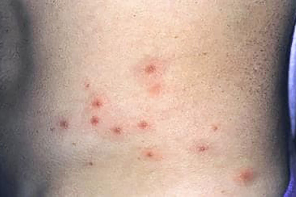Атопический дерматит или воспаление кожи