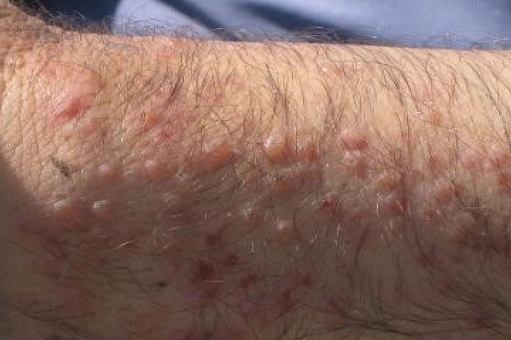 Так выглядит сыпь, связанная с церкариальным дерматитом. Источник: sciencedirect.com
