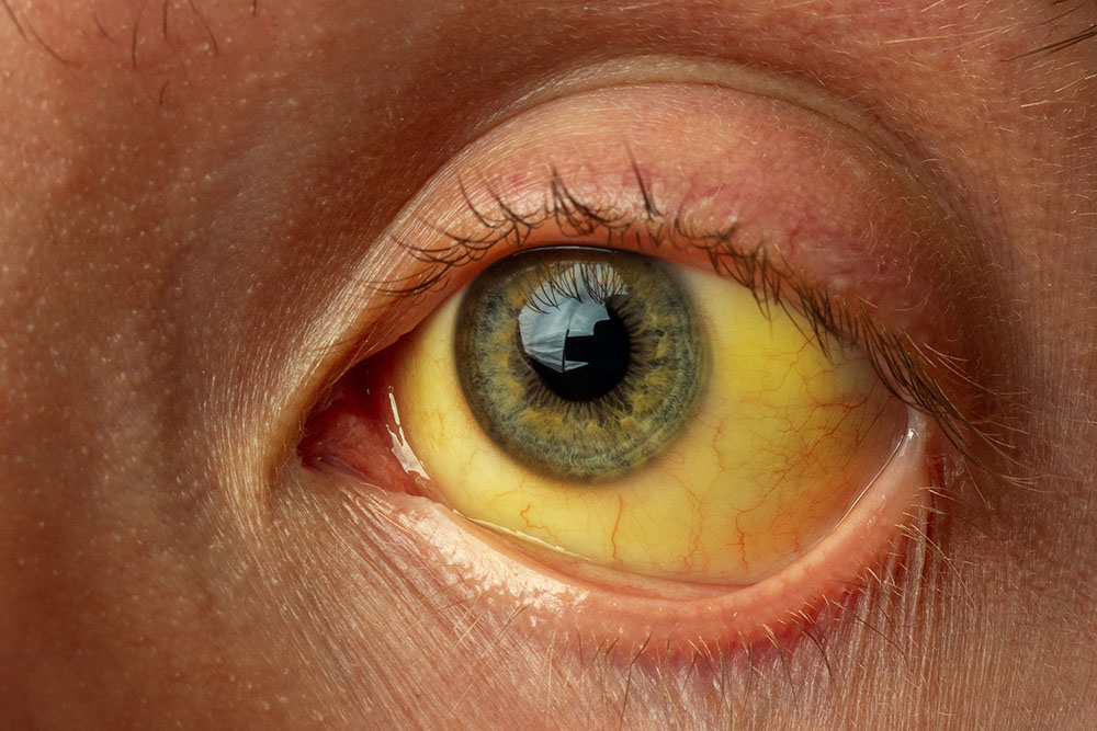 У некоторых людей при гепатите А кожа и белки глаз становятся желтоватыми. Источник: daniiD / Shutterstock