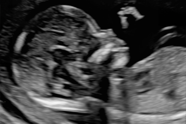 УЗИ на 14⁠—⁠15⁠-⁠й неделе беременности. Источник: fomin-clinic.ru