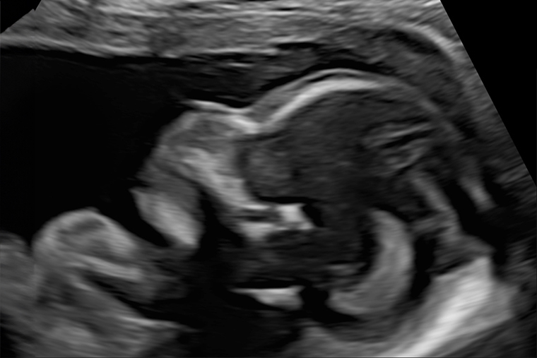 УЗИ на 17⁠—⁠18⁠-⁠й неделе беременности. Источник: fomin-clinic.ru