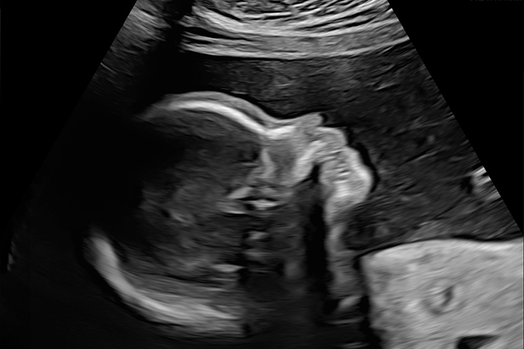 УЗИ на 22⁠—⁠23⁠-⁠й неделе беременности. Источник: fomin-clinic.ru