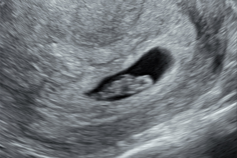УЗИ на 8⁠—⁠9⁠-⁠й неделе беременности. Источник: fomin-clinic.ru