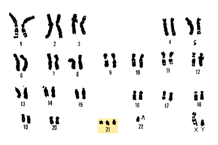 В норме у человека 46 хромосом. При синдромах Дауна, Эдвардса и Патау количество хромосом увеличивается до 47. Например, при синдроме Дауна есть лишняя 21⁠-⁠я хромосома. Источник: downsideup.org