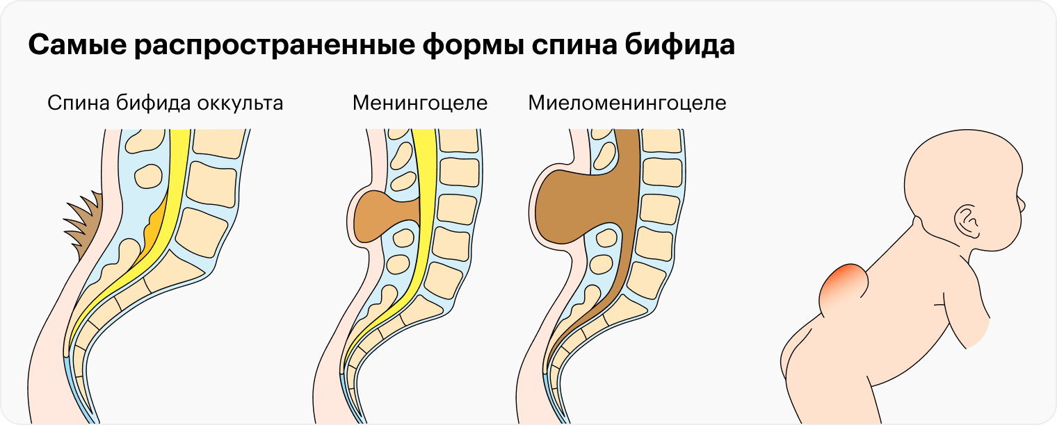 В зависимости от степени расщепления позвоночника спинной мозг и нервы развиваются внутри тела или на наружной части спины
