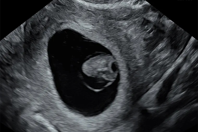 УЗИ на седьмой-восьмой неделе, нормальная беременность. Источник: fomin-clinic.ru