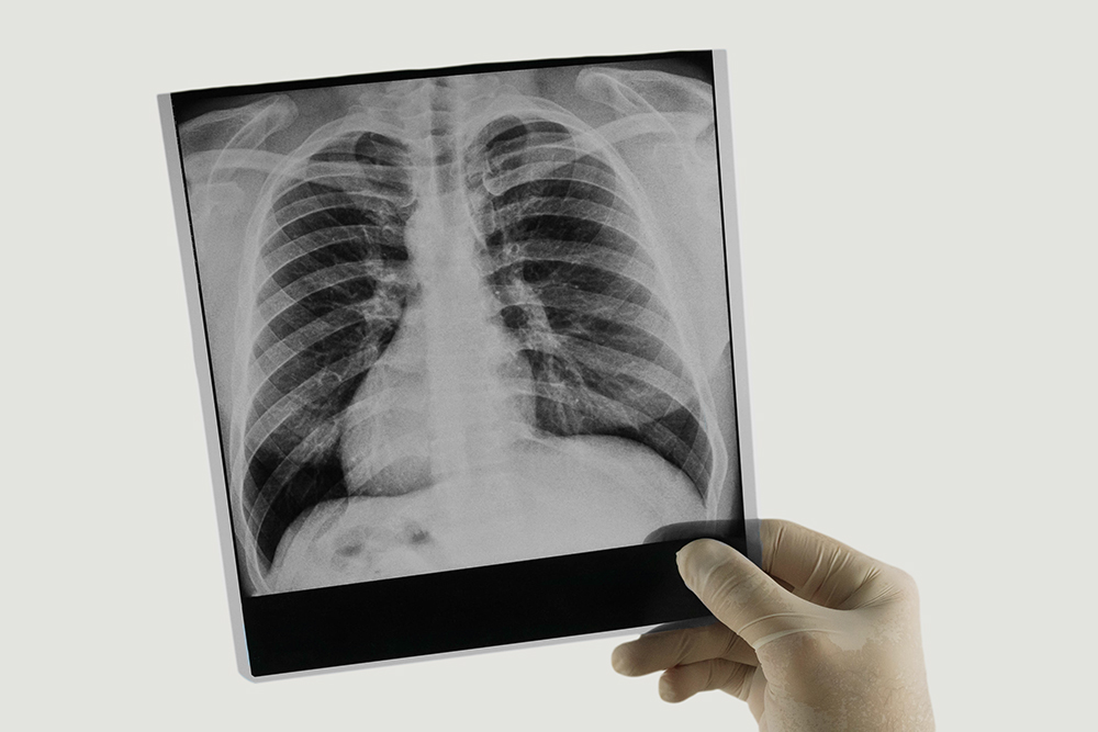 Диагностика и борьба с туберкулезом