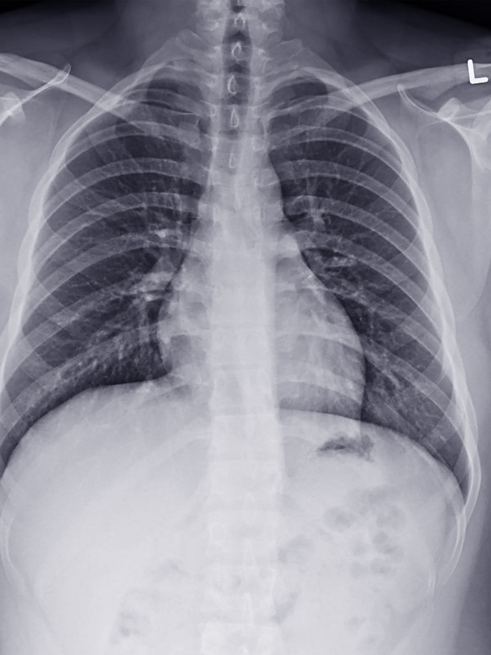 Рентген легких и флюорография у детей – с какого возраста