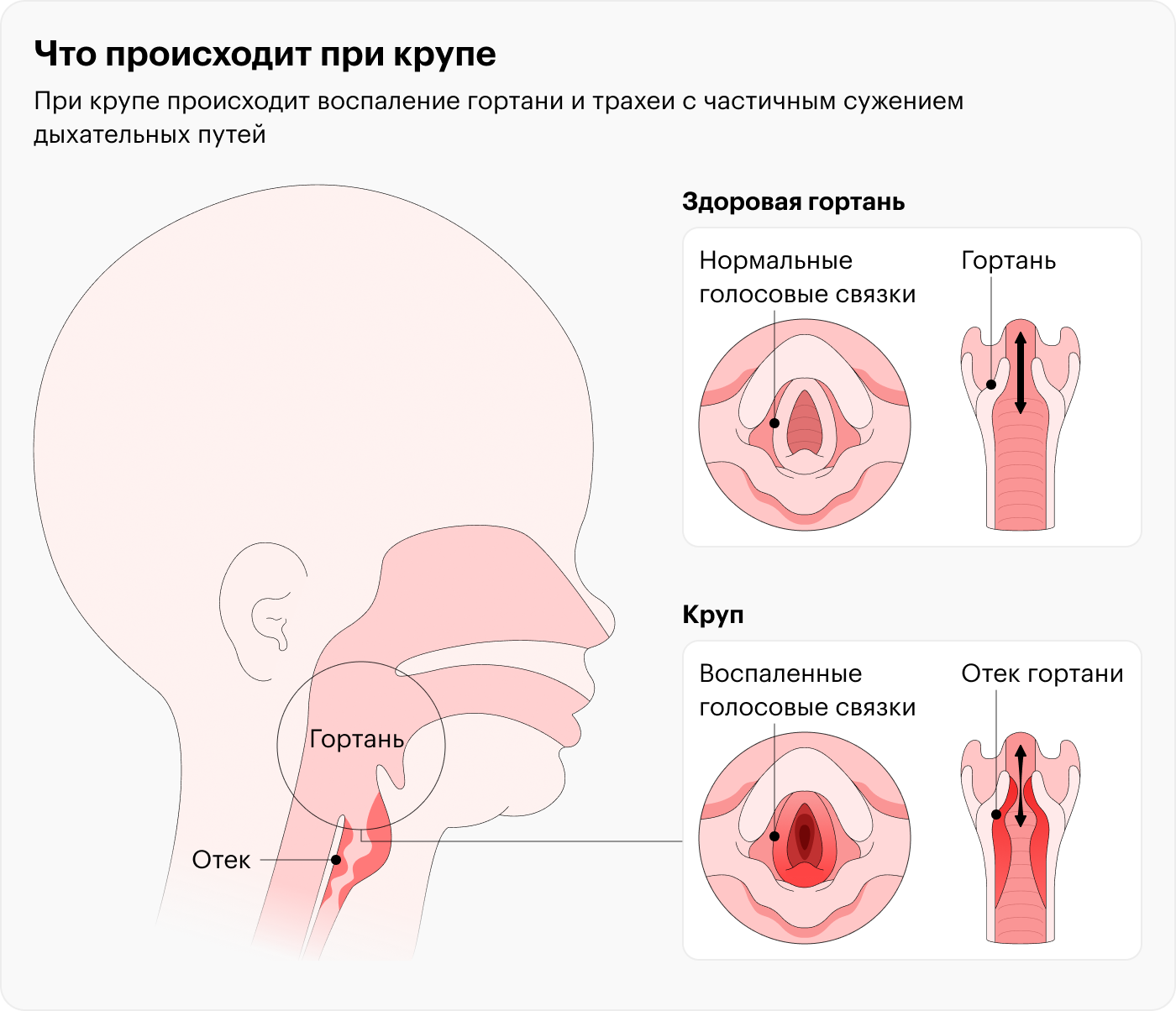 Лечение ложного крупа у ребенка. Снятие приступа. Клиника Фэнтези в Москве