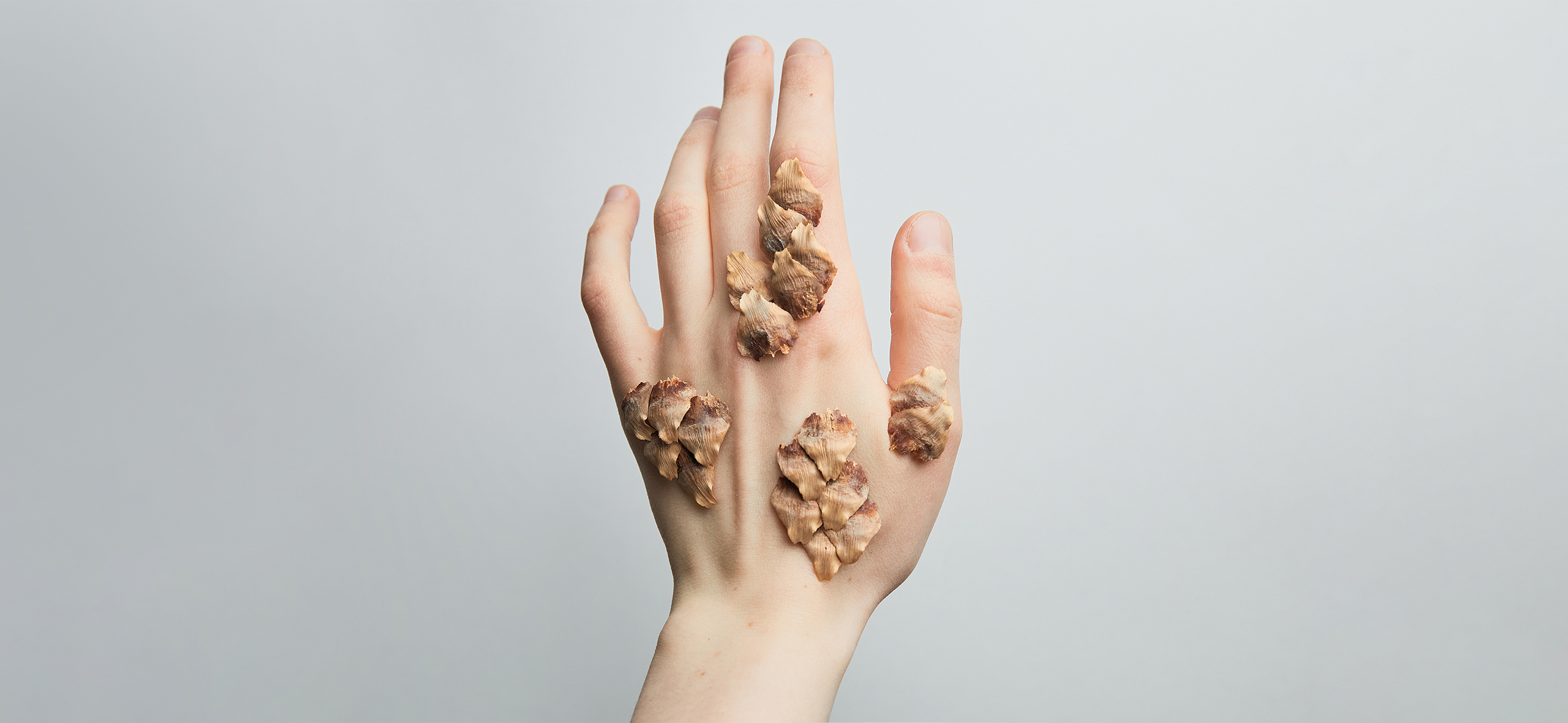 Что такое псориаз и как его лечить: рассказывает дерматолог