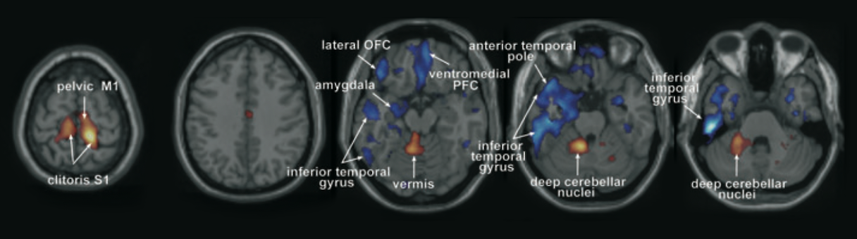Изображение мозга женщины: желто-красным отмечены области, активные во время оргазма, синим — участки, более активные в состоянии покоя. Источник: pubmed.ncbi.nlm.nih.gov