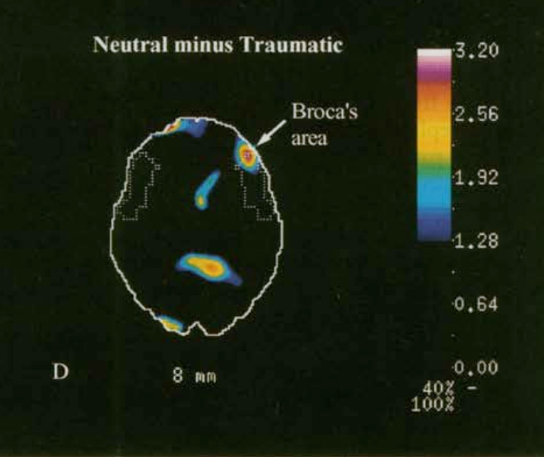 Когда человек с ПТСР вспоминает о событии, которое его травмировало, ученые регистрируют снижение кровотока в зоне Брока — речевом центре мозга. Источник: Utrecht University