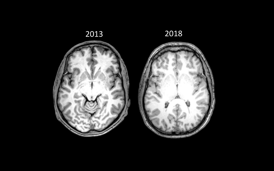 Сканы мозга Брайана Пенни: слева — первый, сделанный в 2013 году, справа — повторный, сделанный в 2018 году. На них видно переднюю комиссуру мозга — анатомическую структуру, на которую ученые ориентируются, когда сравнивают один скан с другим. Источник: Medium