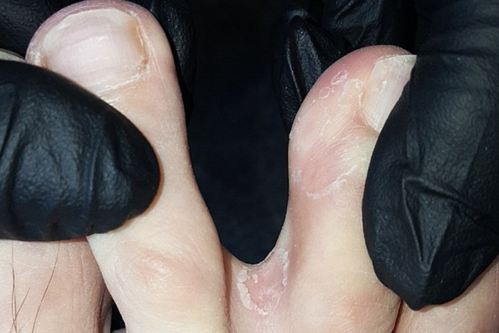 При межпальцевом дерматомикозе кожа чаще всего начинает шелушиться между третьим и четвертым пальцами ног. Источник: Tang21237 / Wikimedia