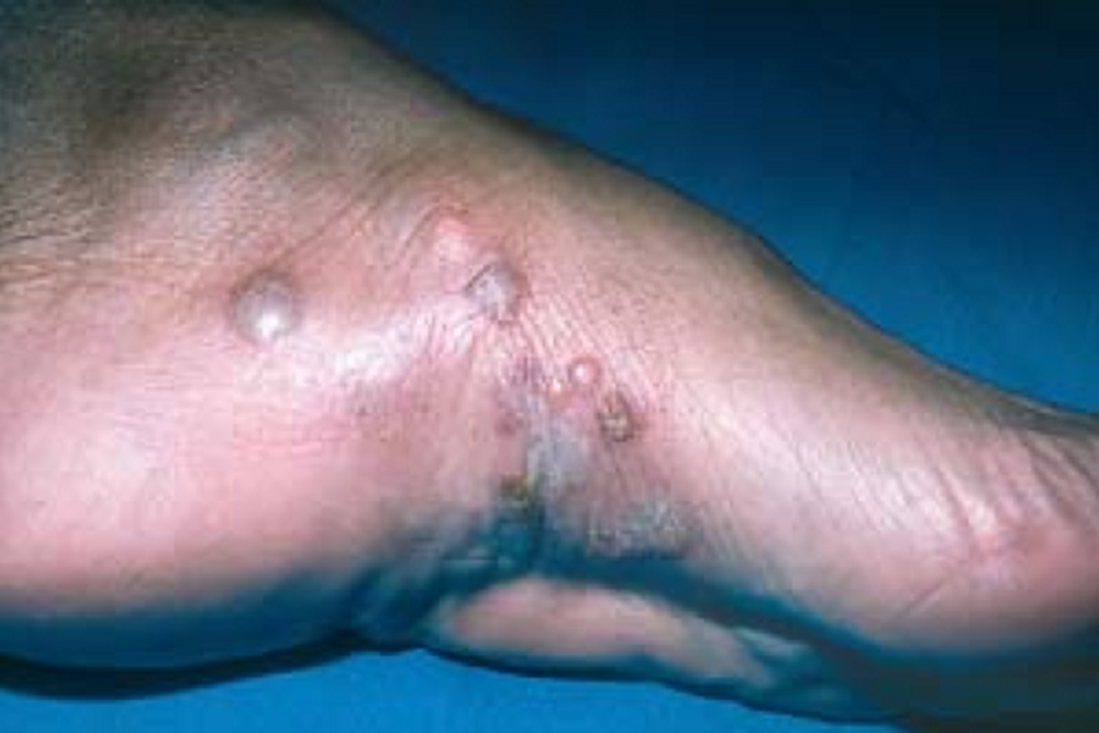 При воспалительном дерматомикозе зудящие пузырьки обычно появляются на подъеме стопы или чуть выше. Источник: ​​plasticsurgerykey.com