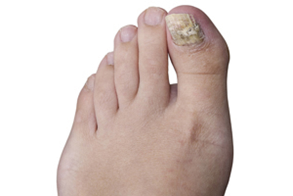 Ноготь утолщается, желтеет и крошится. Источник: cdc.gov