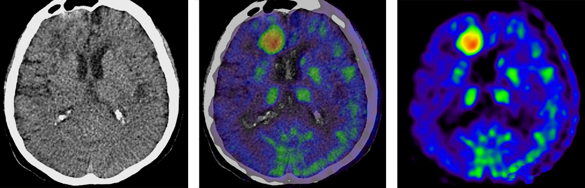 Слева — компьютерная томография мозга, справа — данные позитронно-эмиссионной томографии. На КТ врач не видит патологические очаги, накапливающие радиоактивное вещество. На ПЭТ/КТ они хорошо видны, но непонятно, где именно в мозге они расположены. Совмещая два исследования, можно точно определить расположение и размер очагов. Источник: adrad.com