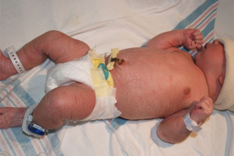 Так выглядит нормальное шелушение кожи ребенка на второй день после рождения. Источник: med.stanford.edu