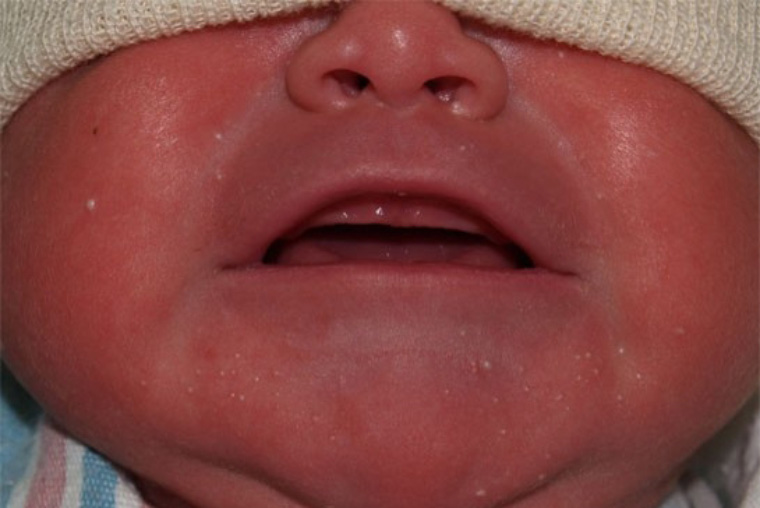 Гормональная сыпь у новорожденных и грудничков: признаки и лечение – статьи от АО Медицина