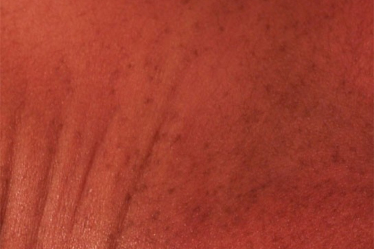 Так выглядит пустулярный меланоз на стадии пигментации сыпи. Источник: med.stanford.edu