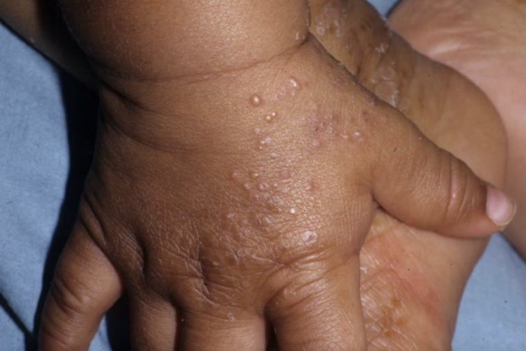 Проявления акропустулеза на руках у ребенка. Источник: emedicine.medscape.com