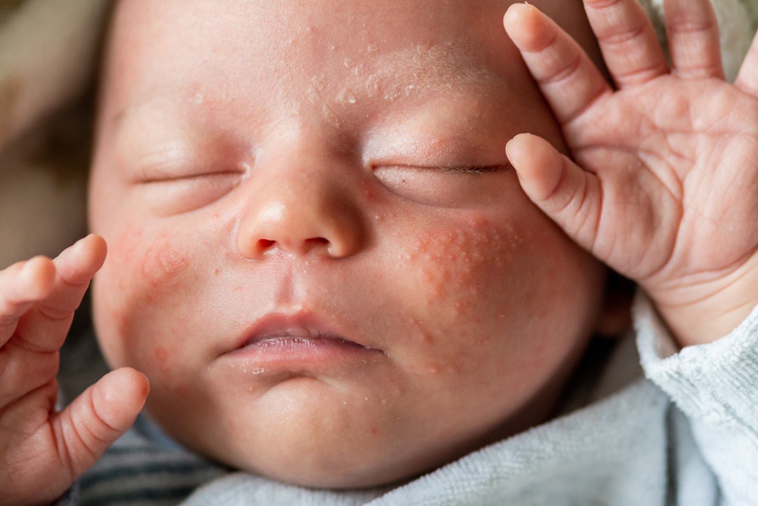 Акне новорожденных. Фото: Cerrotalavan / Shutterstock