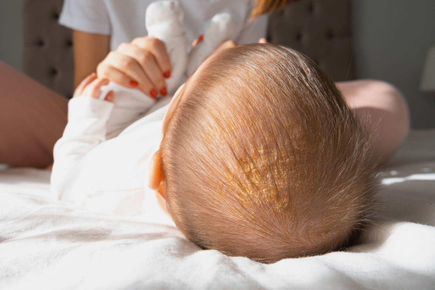 «Молочные корочки» на голове у ребенка. Фото: Kadir Cigsar / Shutterstock