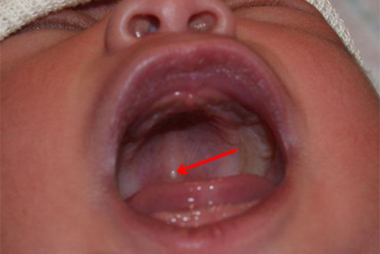 Белые точки и прыщики на десне у грудничка: фото, симптомы и способы лечения налета во рту
